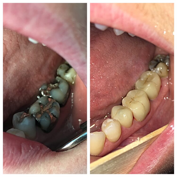 dental restoration by Dr. Daniel Cohen at South Florida Dental Center in Coral Springs Florida