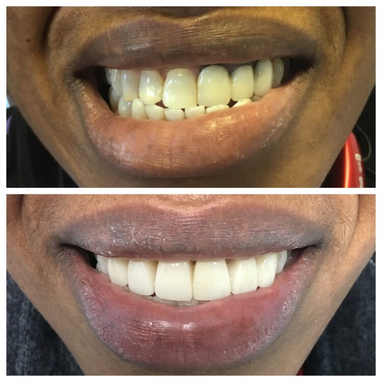 dental restoration by Dr. Daniel Cohen at the South Florida Dental Center in Coral Springs Florida