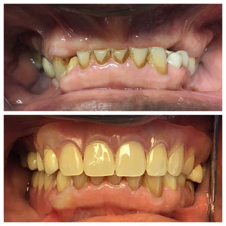 dental restoration from Dr. Daniel Cohen at South Florida Dental Center in Coral Springs Florida