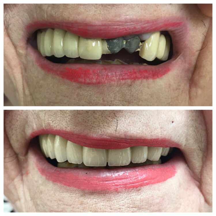 dental implants by Dr. Daniel Cohen at South Florida Dental Center in Coral Springs Florida