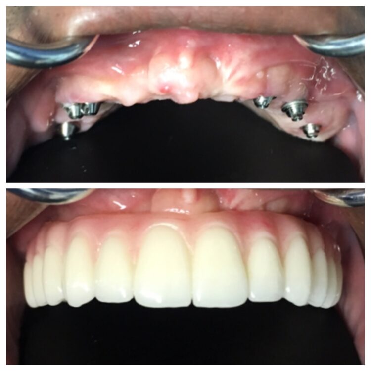 Dental restoration by Dr. Daniel Cohen at South Florida Dental Center in Coral Springs Florida