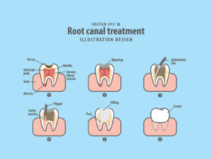 signs you need a root canal