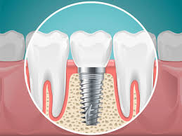 dent-implant