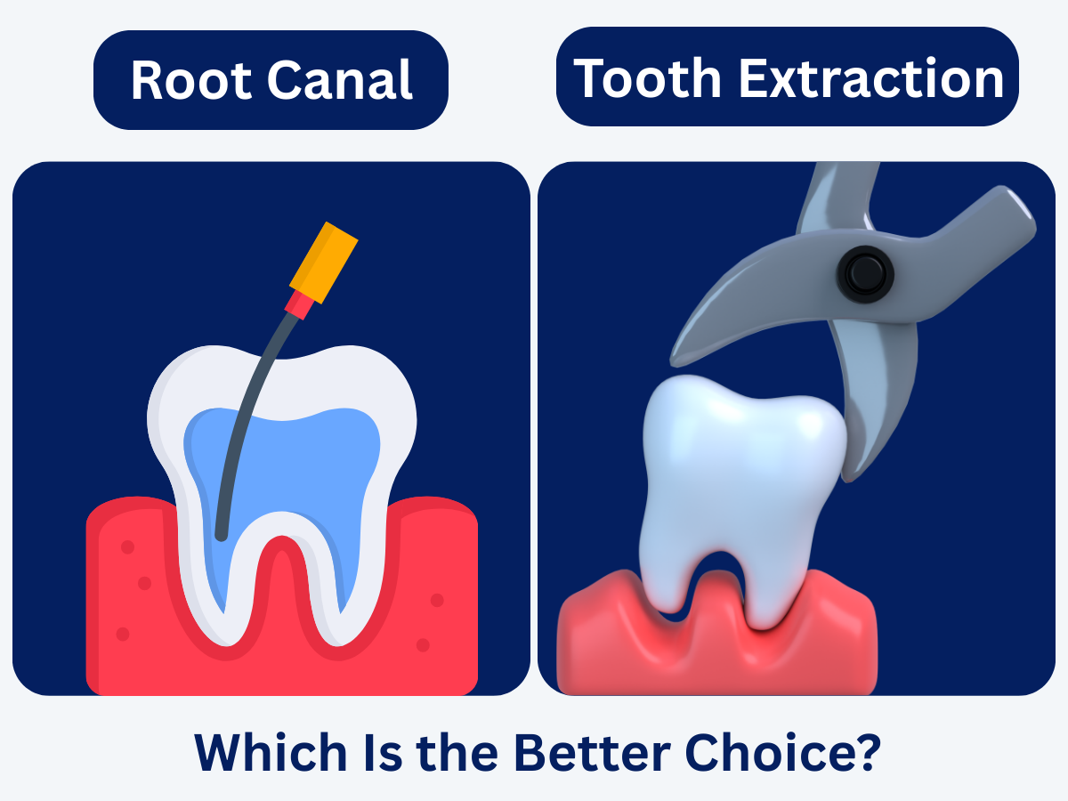 Root Canal vs Tooth Extraction: