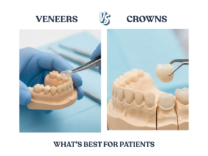 Veneers vs Crowns