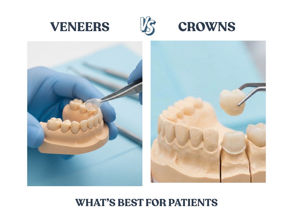Veneers vs Crowns