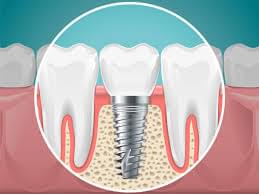 dent-implant