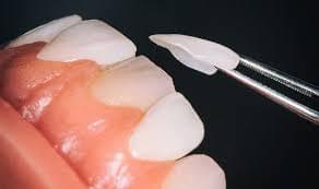 veneers